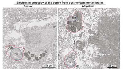 電子顯微照片展示了92歲健康女性前額葉皮質(zhì)中的典型小膠質(zhì)細(xì)胞（左），以及91歲阿爾茨海默病女性患者的暗色小膠質(zhì)細(xì)胞（右）。圖片來(lái)源：美國(guó)紐約市立大學(xué)
